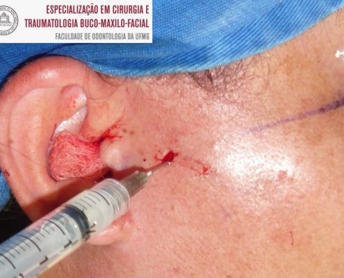 Aplicação de Corticóide intra-articular ao final do procedimento